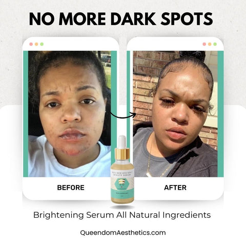 Dark Marks & Hyperpigmentation Kit