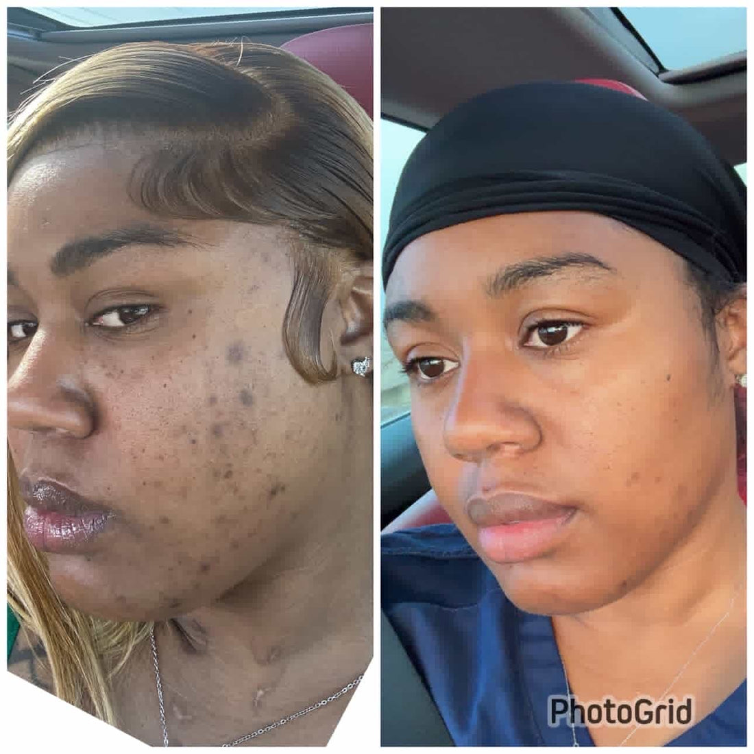 Dark Marks & Hyperpigmentation Kit