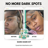 Dark Marks & Hyperpigmentation Kit