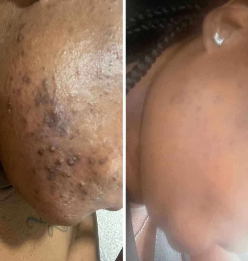 Dark Marks & Hyperpigmentation Kit