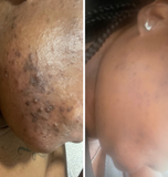 Dark Marks & Hyperpigmentation Kit