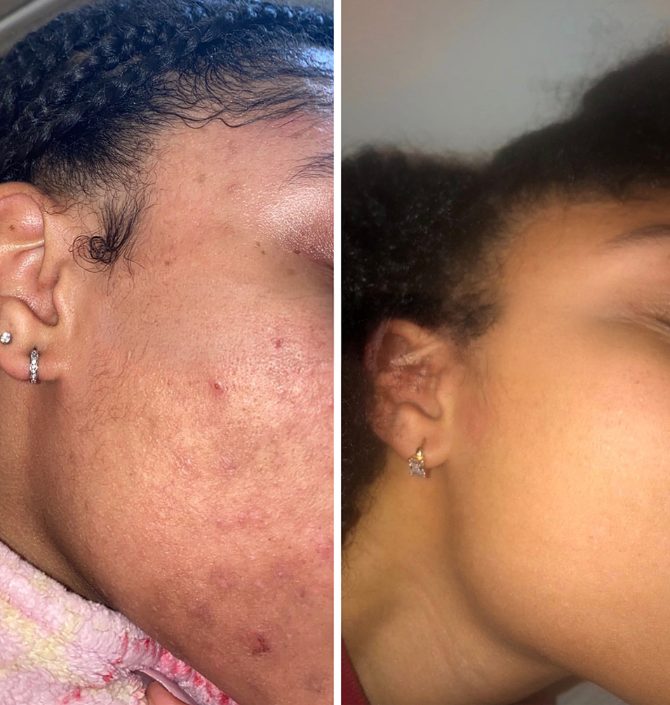 Dark Marks & Hyperpigmentation Kit