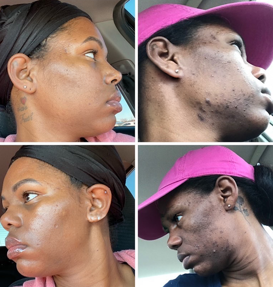 Dark Marks & Hyperpigmentation Kit